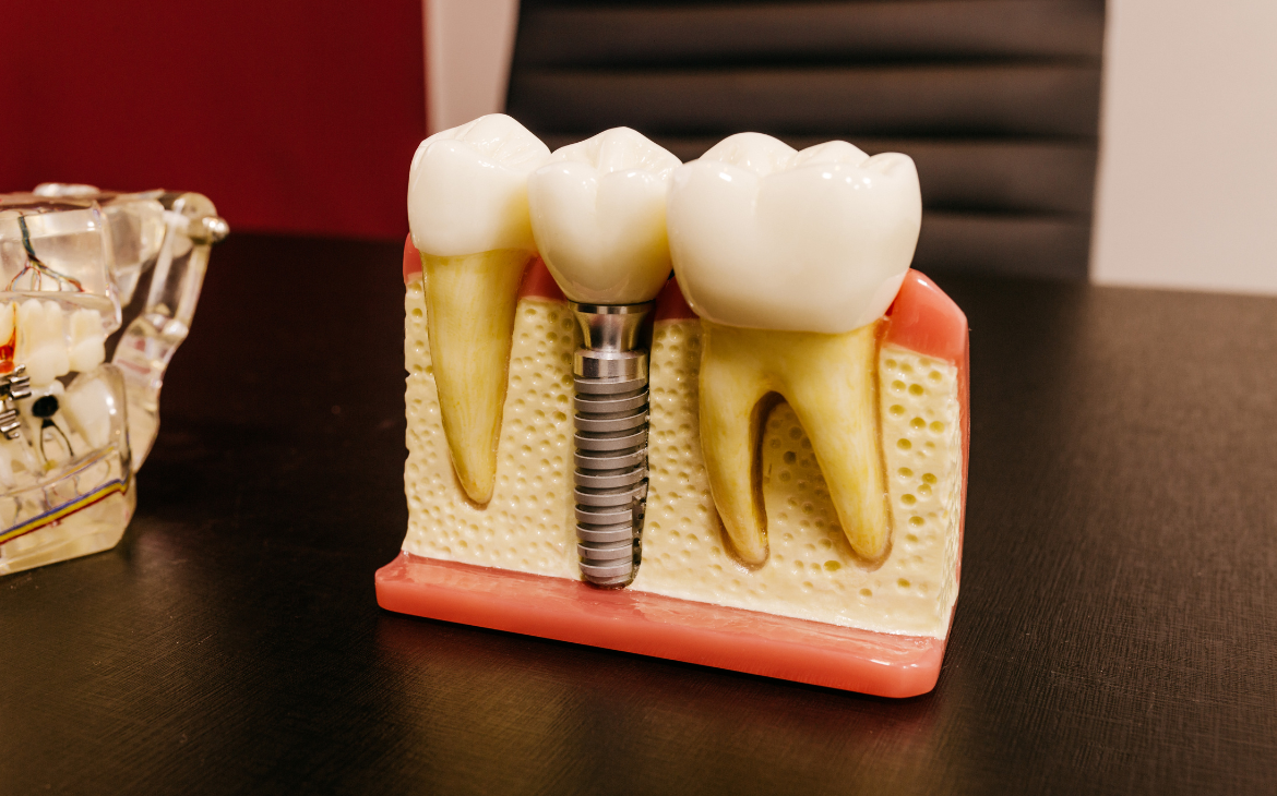 Implantes Dentários Implantes Dentários